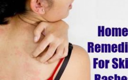 ਲਾਲ ਰੰਗ ਦੇ ਧੱਫੜ ਤੋਂ ਬਚਾਅ ਦੇ ਘਰੇਲੂ ਓਪਾਅ ਜਾਣੋ