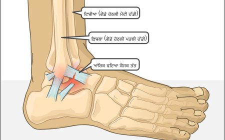 ਗਿੱਟੇ ਦੀ ਮੋਚ ਅਤੇ ਇਸਦਾ ਇਲਾਜ਼ ਕਿਸ ਤਰਾਂ ਕੀਤਾ ਜਾਂਦਾ ਹੈ, 